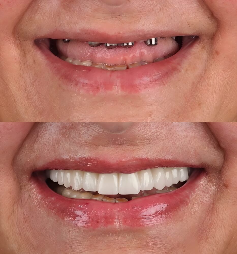 Before and after dental implants
