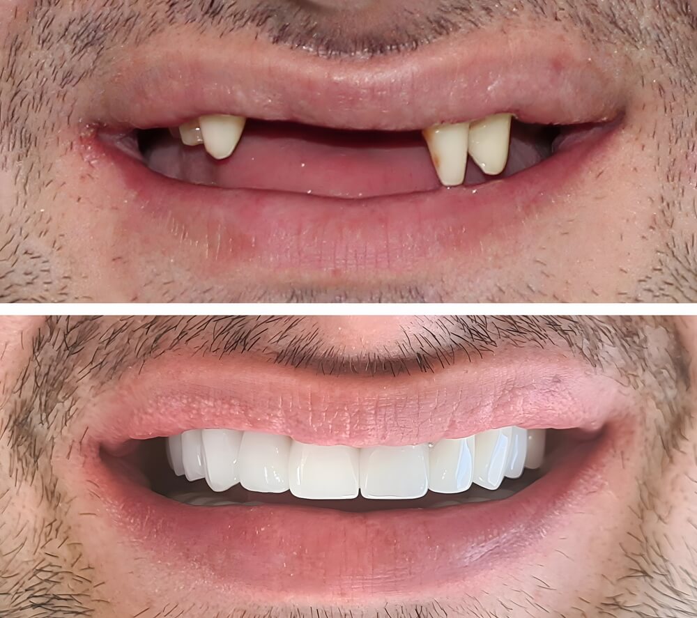 Before and after dental implants