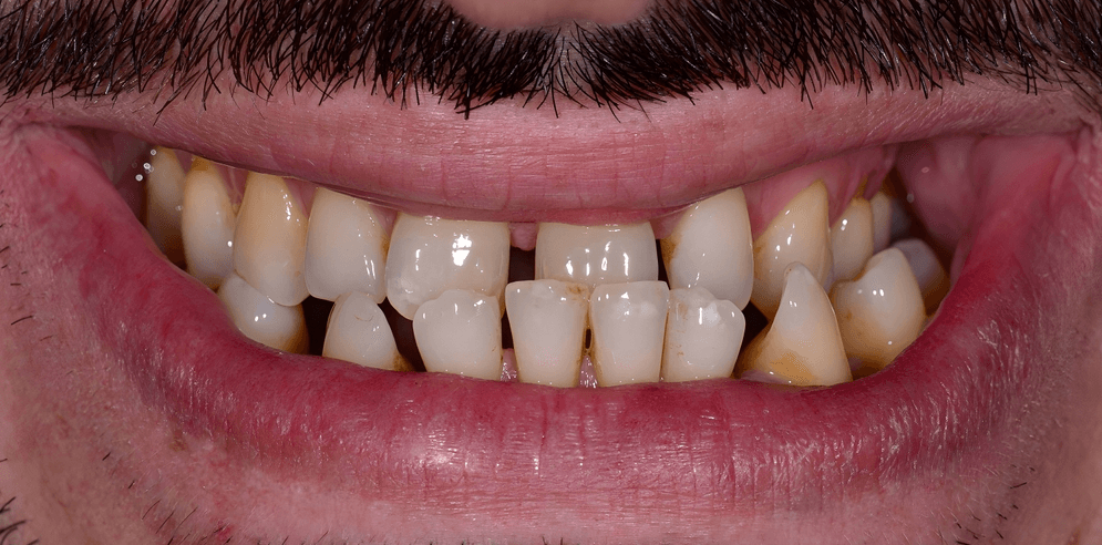 Before Smartee Braces