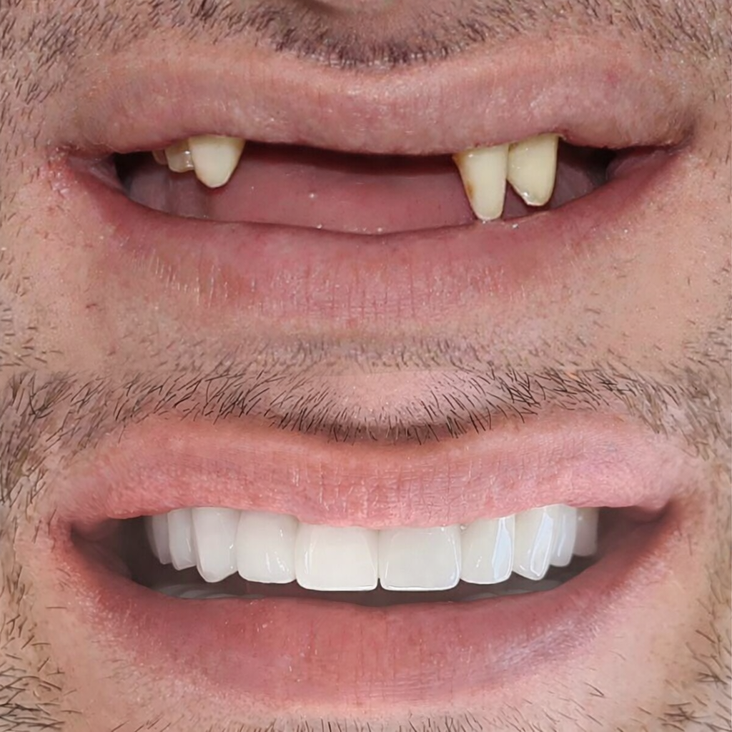 Before and after dental implants
