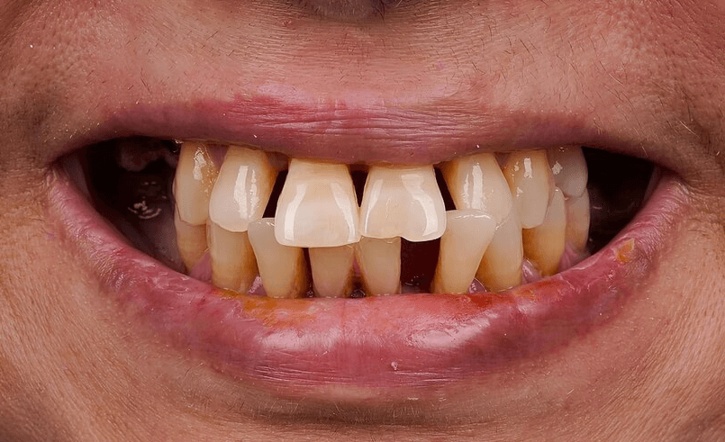 Before Smartee Braces