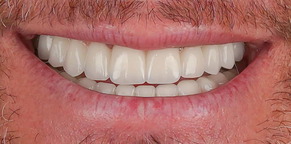 After Smartee Braces