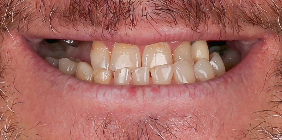 Before Smartee Braces